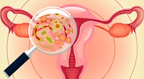 Ілюстрація бактеріального вагінозу