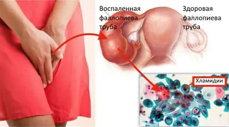 Ілюстрація хламідіозу